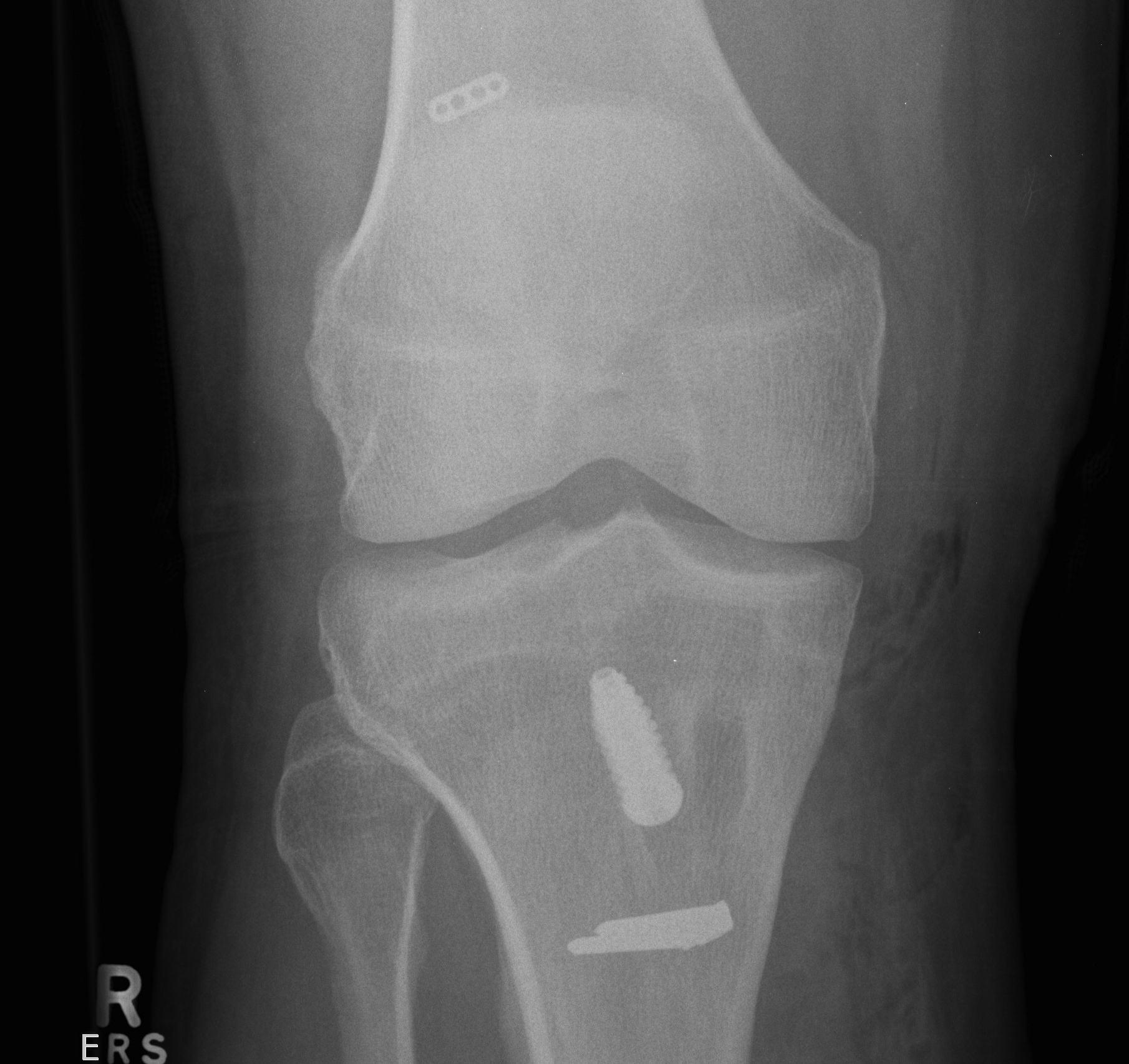 ACL Reconstruction PFJ AP